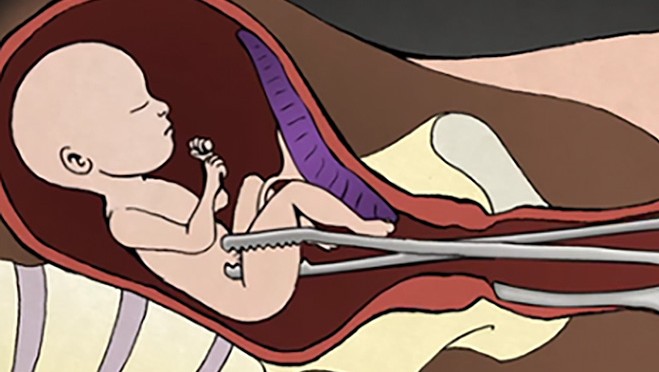 Abortion-Procedures-DE-Levatino-forceps-NAF-672x372