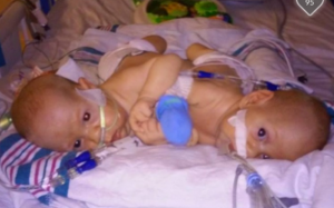 Carter and Connor Mirabal's parents rejected abortion after they heard their sons would be born as conjoined twins.